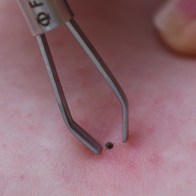 Zeckenpinzette mit Federmechanismus 8,5 cm – Bild 2